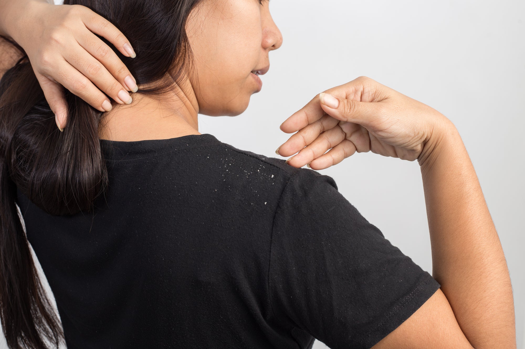 How to get rid of dandruff and retrieve your healthy hair